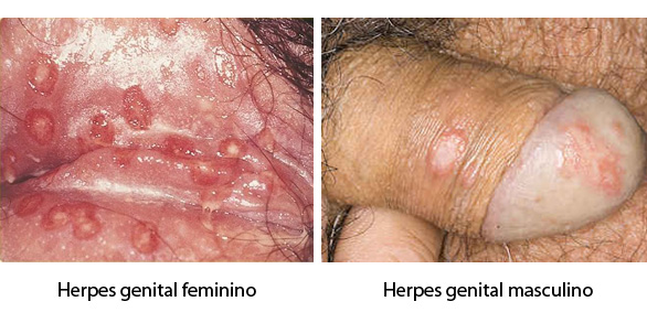 O Herpes Só Se Transmite Por Contacto Sexual-9462